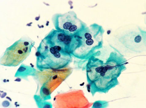 医療専門家がコルポスコピーを推奨するのはいつですか?