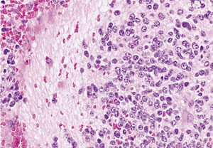 小児腫瘍の細胞診 （5）－神経芽腫 Neuroblastoma