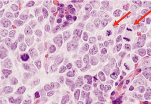 小児腫瘍の細胞診 （5）－神経芽腫 Neuroblastoma